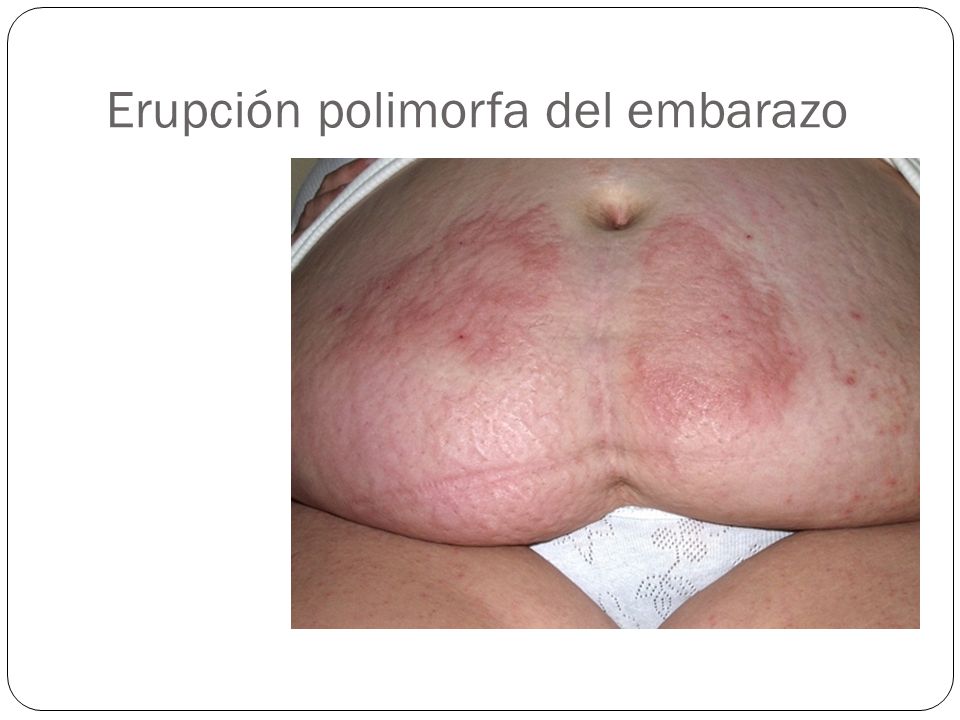 La psoriasis se ha hinchado los pies que hacer